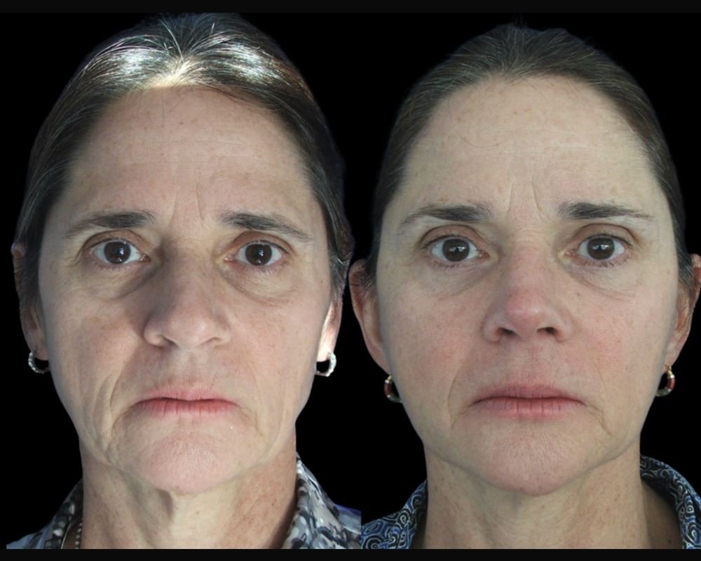 Antes e depois de nanofat — paciente do Dr. Leonardo Gomes