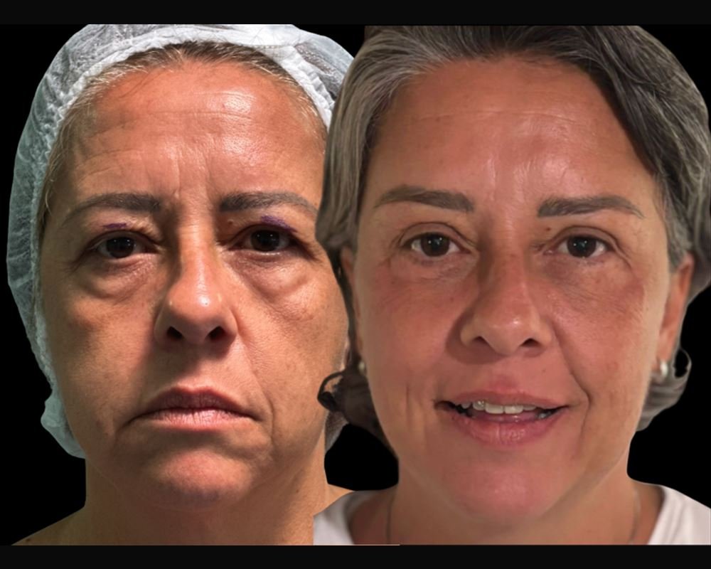 Antes e depois de blefaroplastia — paciente do Dr. Leonardo Gomes