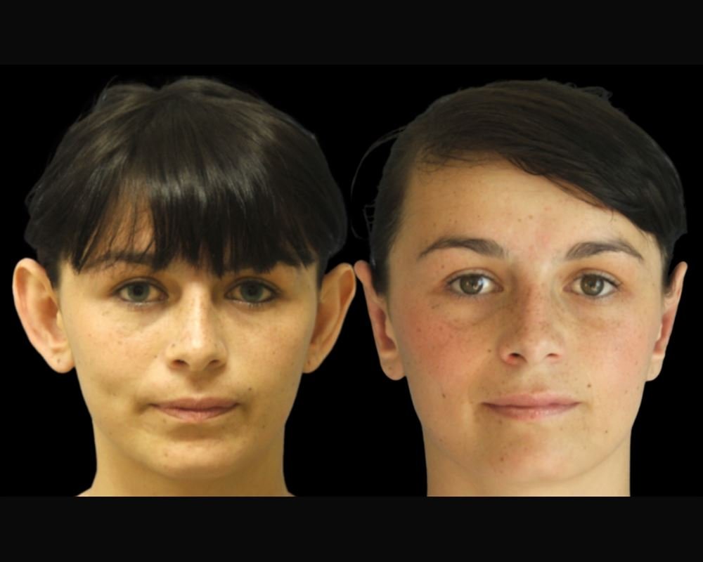 Antes e depois de otoplastia — paciente do Dr. Leonardo Gomes