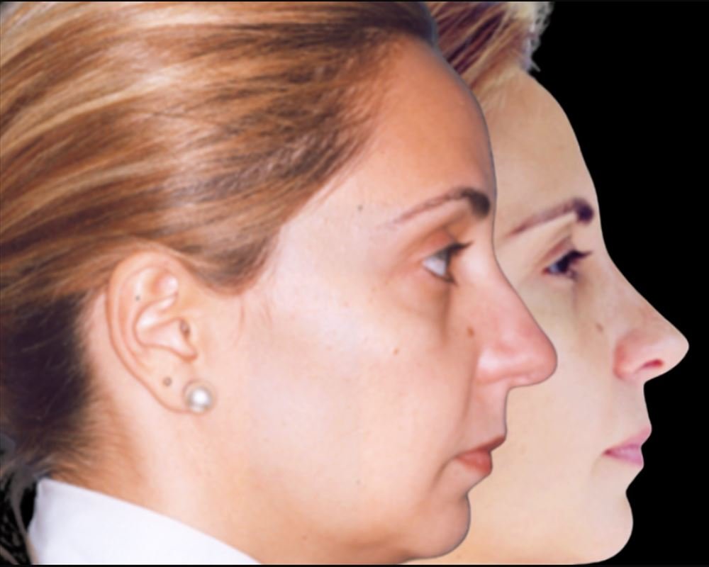 Antes e depois de rinoplastia — paciente do Dr. Leonardo Gomes