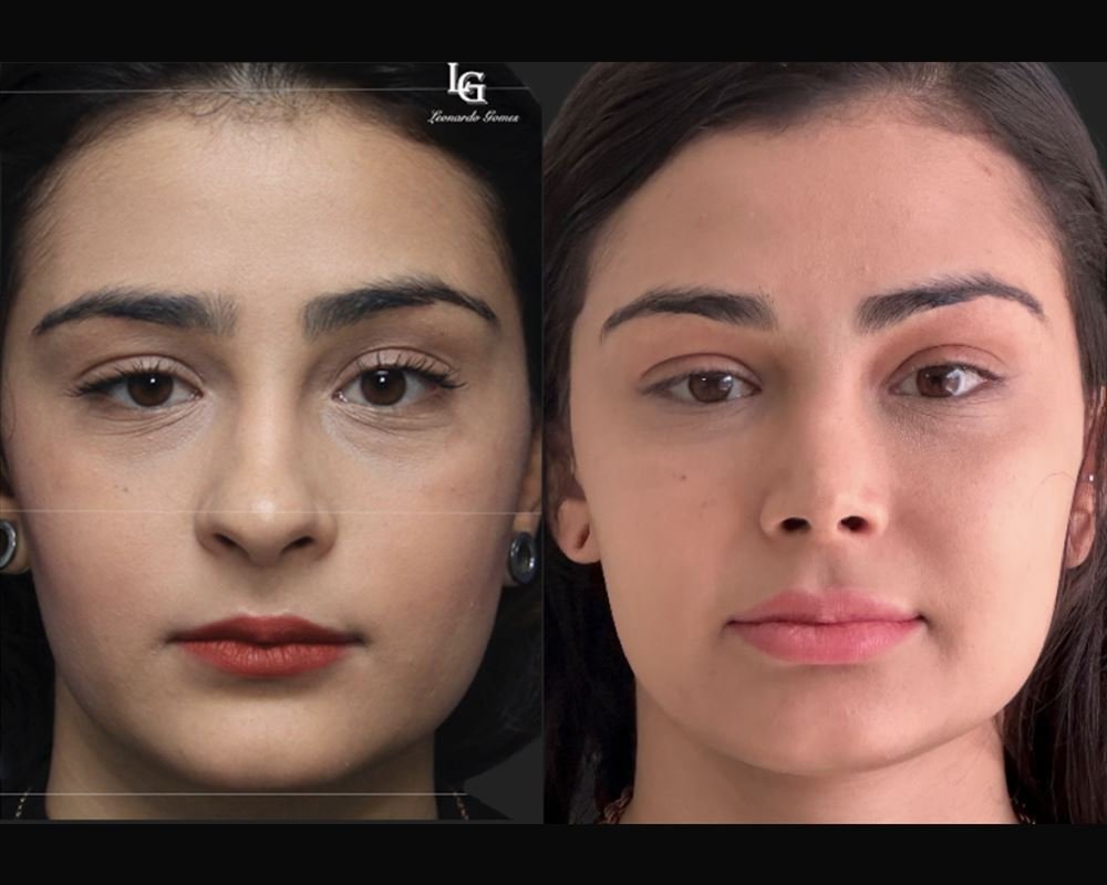 Antes e depois de lifting facial — paciente do Dr. Leonardo Gomes