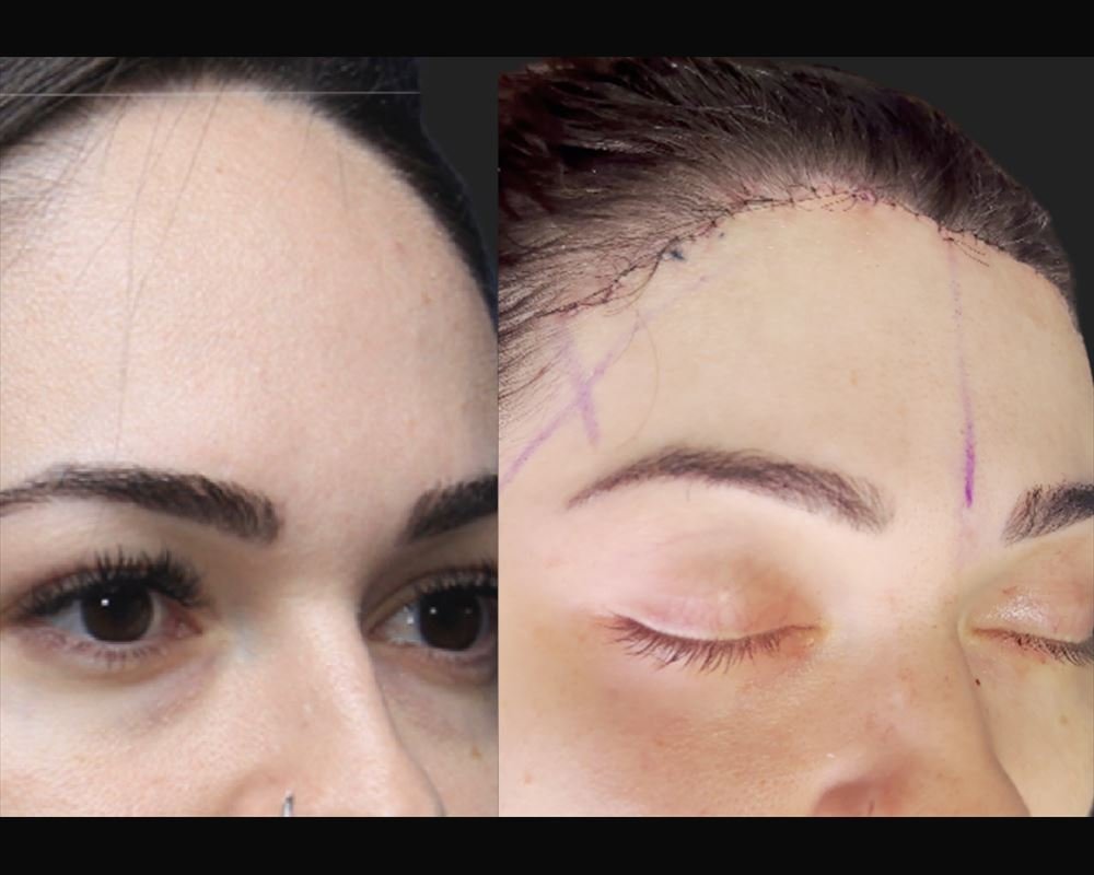 Antes e depois de frontoplastia — paciente do Dr. Leonardo Gomes